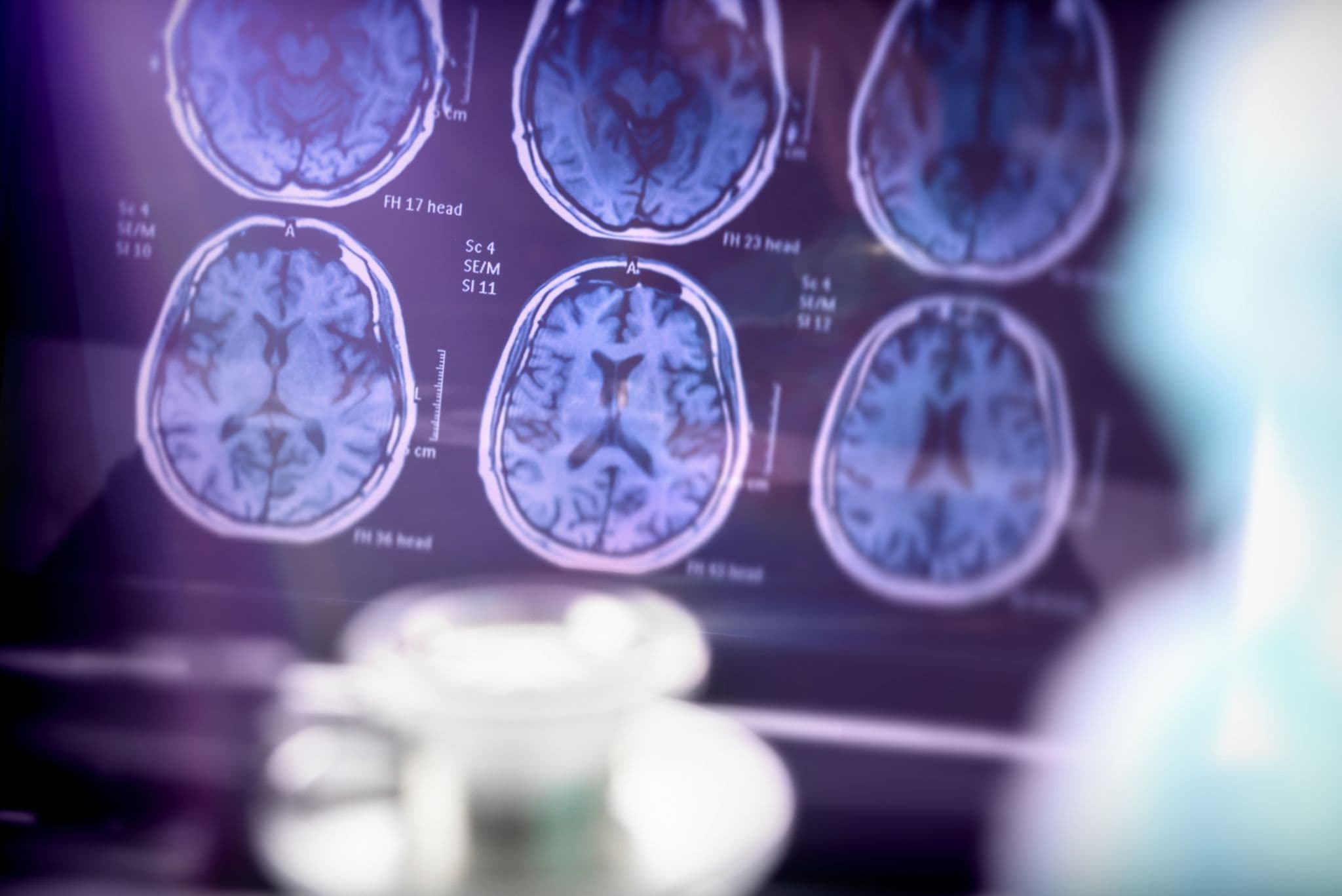 Radiografía del cerebro